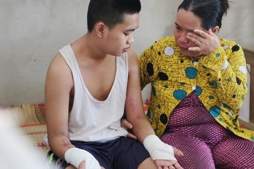 Người mẹ đơn thân bật khóc cầu xin cứu đôi tay hoại tử của con trai 18 tuổi