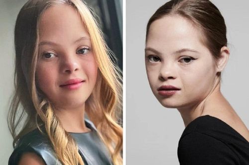 Cô bé mắc hội chứng Down bị bỏ rơi và hành trình trở thành ngôi sao Hollywood