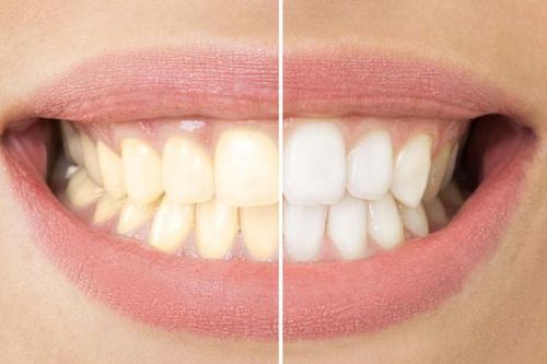 Tự ý tẩy trắng răng bằng sản phẩm mua trên mạng xã hội, lợi bất cập hại