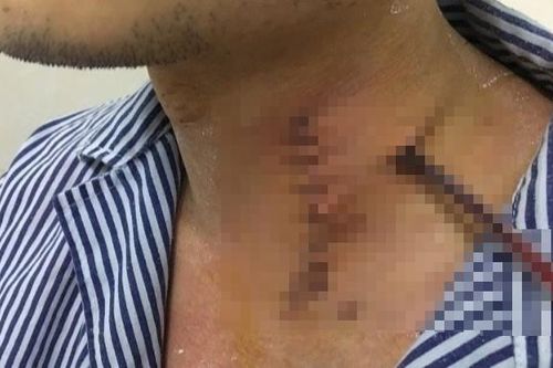 Hy hữu thanh niên bị súng bắn đinh 'bắn' sâu vào cổ