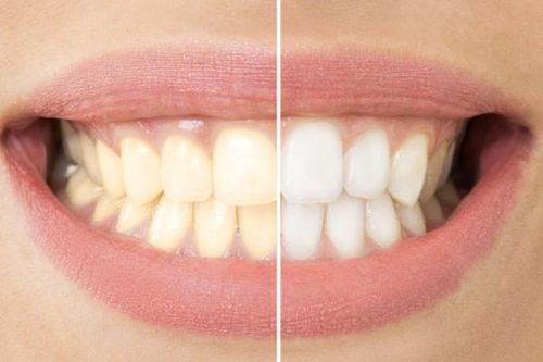 Cách duy trì răng hiệu quả sau khi tẩy trắng