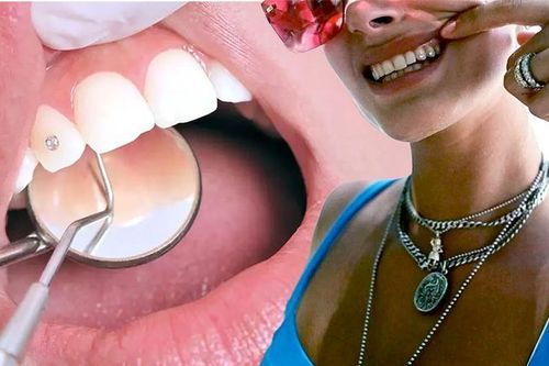Xu hướng đính đá vào răng: Bác sĩ khuyến cáo điều quan trọng khi làm