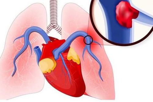 Tắc động mạch phổi - 'kẻ giết người thầm lặng'