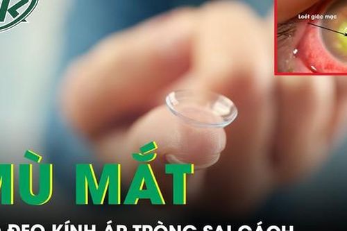 Mù mắt do đeo kính áp tròng sai cách