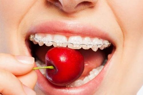 Mẹo nhỏ giúp người niềng răng ăn không bị ê buốt, không tuột mắc cài