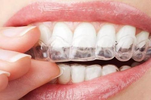 Ưu và nhược điểm của các phương pháp niềng răng