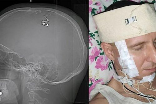 Nhà khoa học Nga gây sửng sốt vì tuyên bố tự phẫu thuật não tại gia