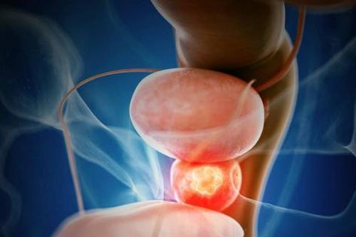 5 điều cần biết về ung thư tuyến tiền liệt