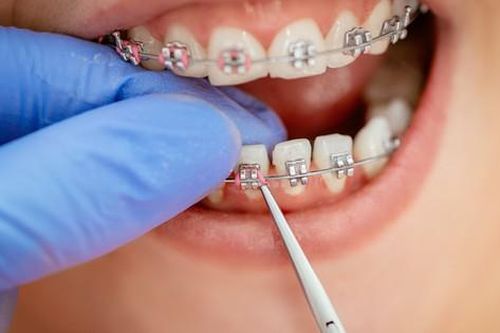 Cần lưu ý gì trước và sau khi niềng răng?