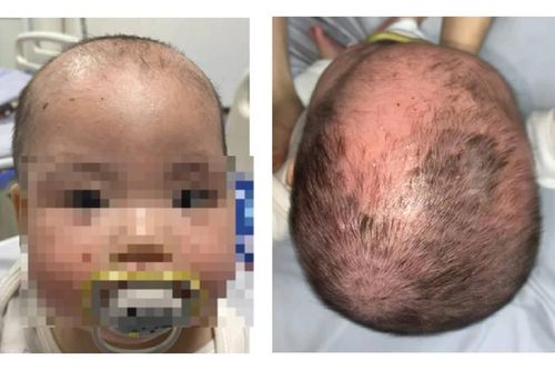 Bé trai nứt da vùng đầu sau 7 tháng tắm lá chữa viêm da cơ địa