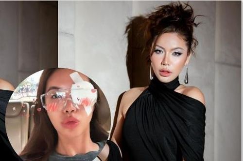 Vừa khâu 10 mũi ở cằm, Minh Tú lại băng bó ở mắt, lộ lý do 'kiếp nạn 84'