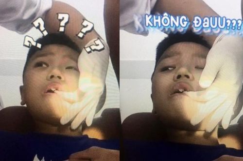 Bé trai 11 tuổi mọc răng thừa ngay giữa 2 răng cửa