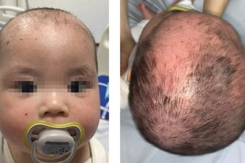 Tắm nhiều loại lá, bé trai 8 tháng tuổi bị bong tróc toàn bộ da mặt và đầu