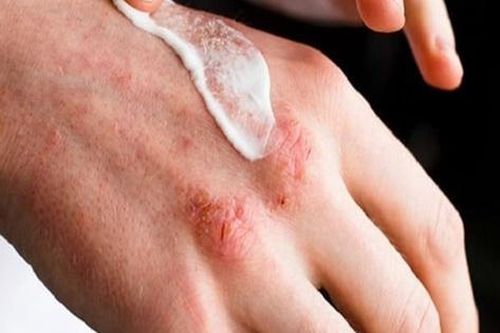 Viêm da tróc vảy: Nguyên nhân và cách điều trị