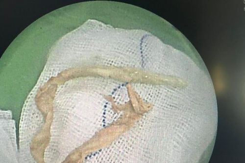 Đoạn khăn giấy dài 15cm trong phế quản người đàn ông