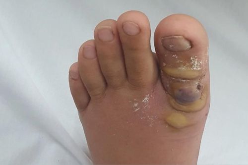 Sau khi nhổ sợi lông chân, thiếu nữ sốt cao phải tức tốc nhập viện