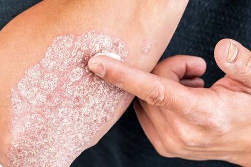 Dùng thuốc chống viêm bôi trị bệnh vảy nến sao cho an toàn?