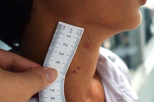 Báo cáo vụ bé trai 14 tuổi bị cha dượng đốt bộ phận sinh dục