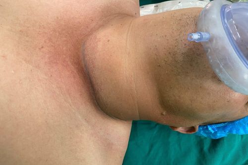 Chủ quan vì nghĩ u tuyến giáp lành tính không cần mổ, nam bệnh nhân diễn biến nặng