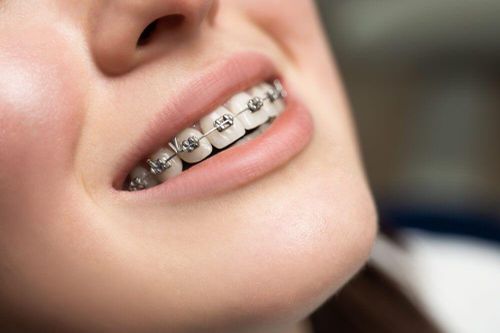 11 quan niệm sai lầm về niềng răng