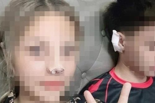 Cô gái nâng mũi bằng sụn tai của bạn trai: Chuyên gia nói gì?