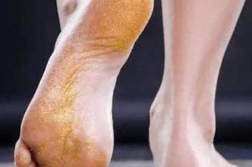 Thấy 5 dấu hiệu này ở bàn chân bạn nên chụp CT gan sớm