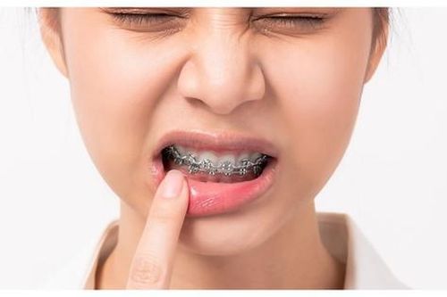Hệ lụy của niềng răng sai cách và cách khắc phục