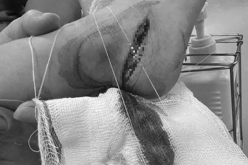 Hà Nội: Bố bất cẩn khiến con trai 3 tuổi bị dao cứa đứt gân chân