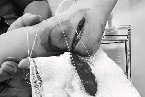 Trẻ đứt gân chân nhập viện cấp cứu do đá phải dao sắc