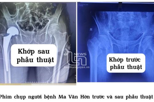 Thay khớp háng thành công cho hai người bệnh 100 tuổi