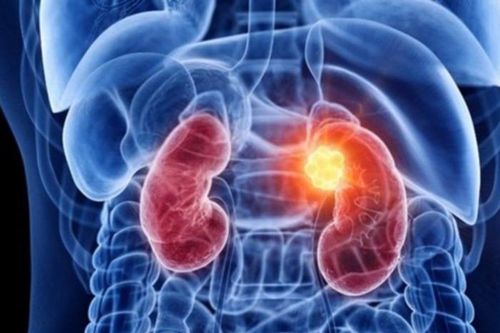 Vôi thận lâu ngày sẽ dẫn đến sỏi thận
