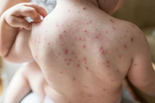 Hà Nội: Số ca mắc thủy đậu, sốt xuất huyết đều tăng
