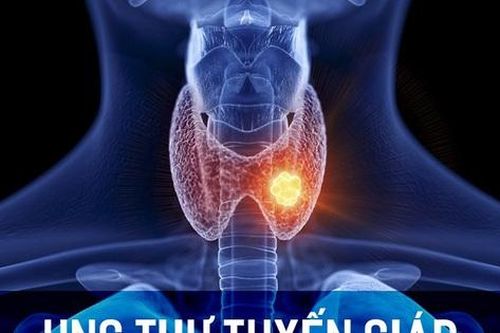 Sau khi điều trị ung thư tuyến giáp có phải uống iod phóng xạ không?