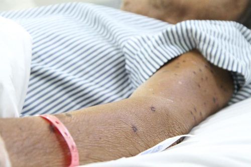 Cứu sống cụ ông U70 bị ong vò vẽ đốt 120 vết
