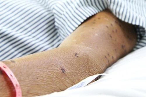 Bạc Liêu: Ông lão thoát chết nhờ cấp cứu kịp thời sau khi bị ong vò vẽ đốt 120 vết