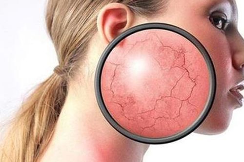 Người bệnh hen sử dụng corticoid kéo dài ảnh hưởng thế nào tới cơ thể?