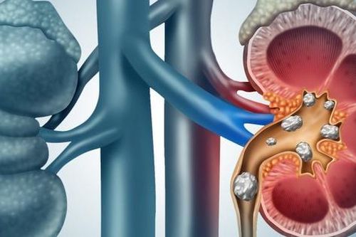 Sỏi thận: Nguyên nhân, dấu hiệu và cách điều trị