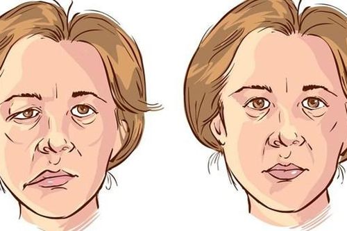 Tắm đêm có phải thủ phạm gây liệt dây thần kinh số 7?
