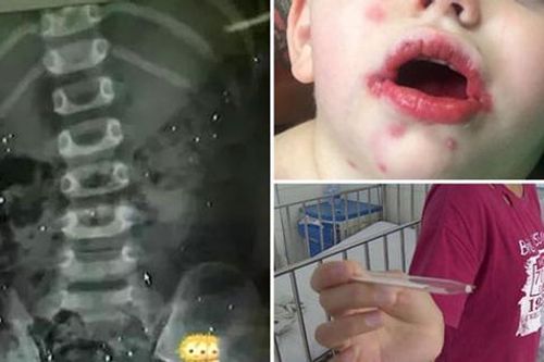 Trẻ ngộ độc thủy ngân do cắn vỡ nhiệt kế