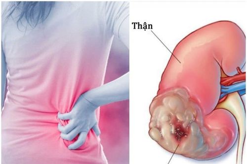 5 dấu hiệu cảnh báo ung thư thận không nên bỏ qua
