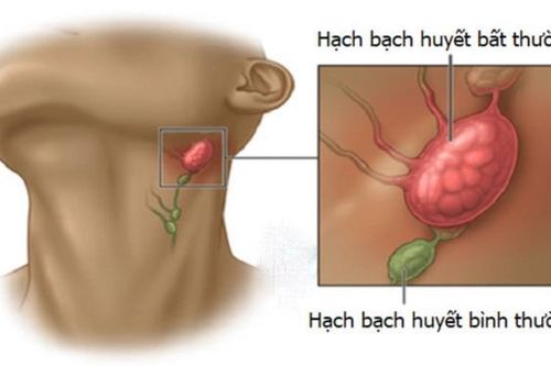 Nổi hạch ở cổ, khi nào là ung thư?