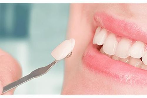 8 lợi ích từ dán sứ veneer
