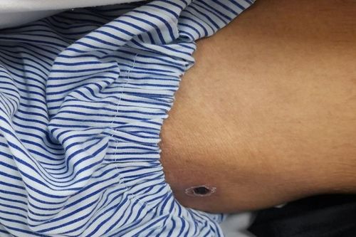 Suy gan, thận vì bị côn trùng cắn