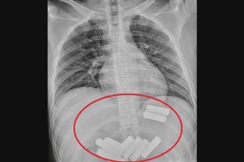Cái kết đắng cho người đàn ông cố tình nuốt 11 viên pin vào bụng