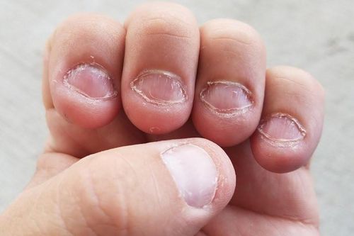 Làm thế nào để bỏ tật cắn móng tay?