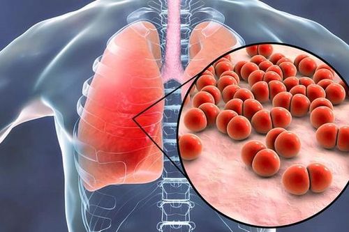 Nấm phổi: Nguyên nhân, dấu hiệu và cách phòng ngừa