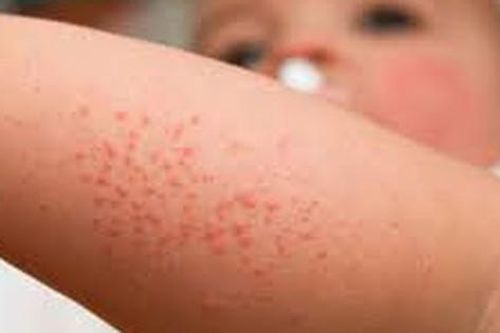 Cách chữa sẩn ngứa ở trẻ em