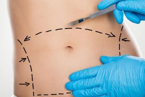 Nguy cơ tắc mạch, hoại tử khi thực hiện hút mỡ bụng tại các cơ sở thẩm mỹ 'chui'