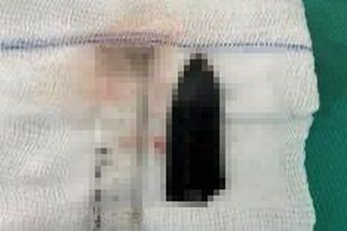 Lấy lưỡi dao dài 10cm ra khỏi cơ thể nam thanh niên