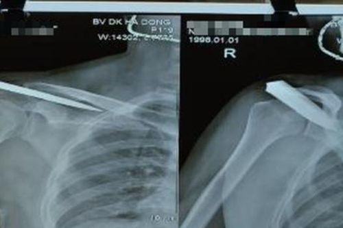 Nam thanh niên nhập viện với lưỡi dao 10cm trong bả vai